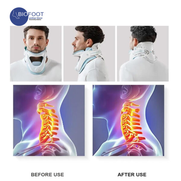 Techlove Adjustable Cervical Collar Soft Neck Brace, LK020A
<br>
جهاز دعم العمود الفقري والعنقي المريح القابل للتعديل مع دعامة الرقبة الناعمة - Image 5
