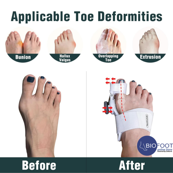 TechLove (1PC)  Orthoepedic Bunion Toe Straighteners Corrector for Women and Men with Silicone Inner Pad for Bunion Pain Relief - Image 2