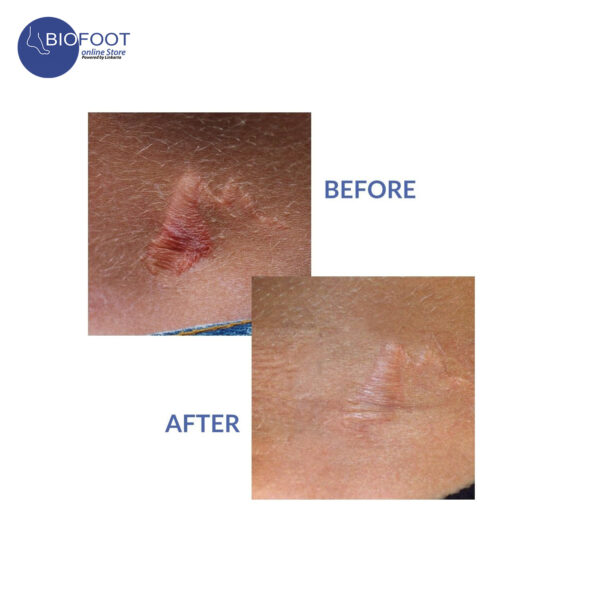 Biodermis Xeragel 100% Silicone Ointment for Scars Clinically Proven to Reduce the Appearance of Old & New Scars 10g - Image 5