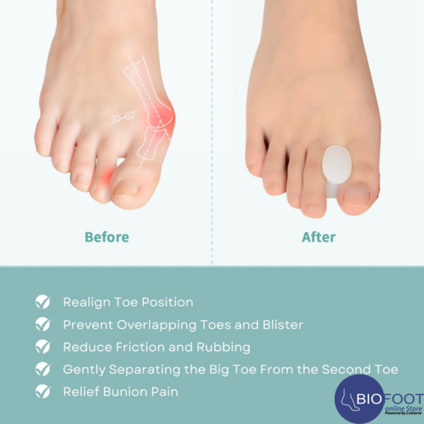 BIOFOOT Silicone Gel Toe Spacers - Effective Separator for Overlapping Toes, Pain Relief, Alignment Support for Crooked or Claw Toes - Unisex, 2-Pack for Comfort and Correction - Image 2