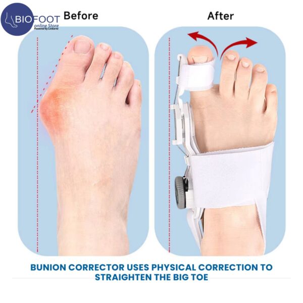 BIOFOOT Micro Adjustable Dial 2024 Orthopedic Bunion Corrector with & Silicone Pad, Big Toe Straightener & Separator, Hallux Valgus Brace for Bunion Pain Relief, 1pc (Left/Right) - Image 3