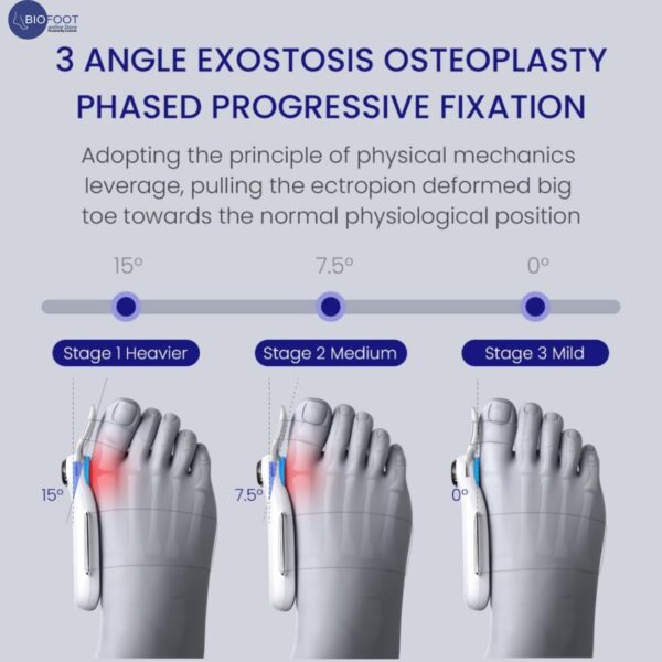 Electric Bunion Corrector, Wireless Big Toe Straightener | 5 Smart Dynamic Air Pressure Training Modes for Hallux Valgus, Adjustable Orthopedic Bunion Brace, Hammer Toe Splint for Pain Relief, 1pc L/R, 500mAh Battery | MONE CorrStage Pro-21-A - Image 7