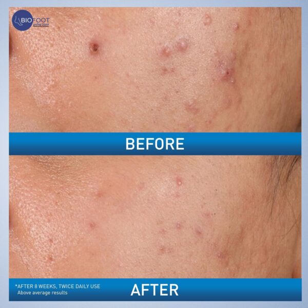 CeraVe Acne Control Gel 2% Salicylic Acid Acne Treatment 40ml - Image 3